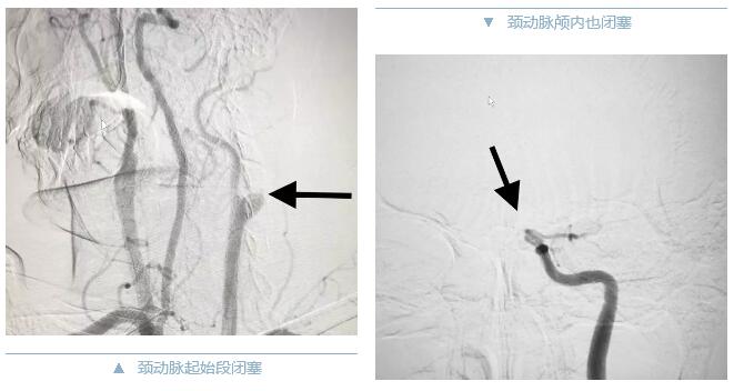 拼1-颈动脉起始及颅内闭塞.jpg