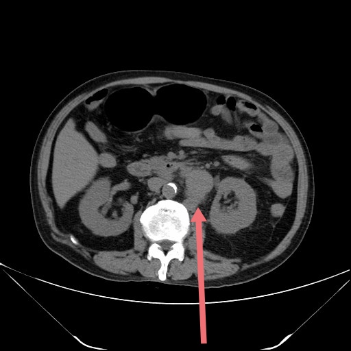 腹腔霍奇金淋巴瘤CT横断面图像.jpg