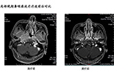 局部晚期鼻咽癌放疗疗效前后对比1