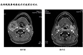 局部晚期鼻咽癌放疗疗效前后对比2