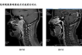 局部晚期鼻咽癌放疗疗效前后对比4