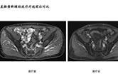 直肠癌新辅助放疗疗效前后对比2