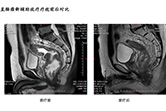 直肠癌新辅助放疗疗效前后对比4